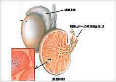 精巣（睾丸）がんイメージ図