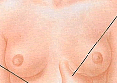 乳がんイメージ図